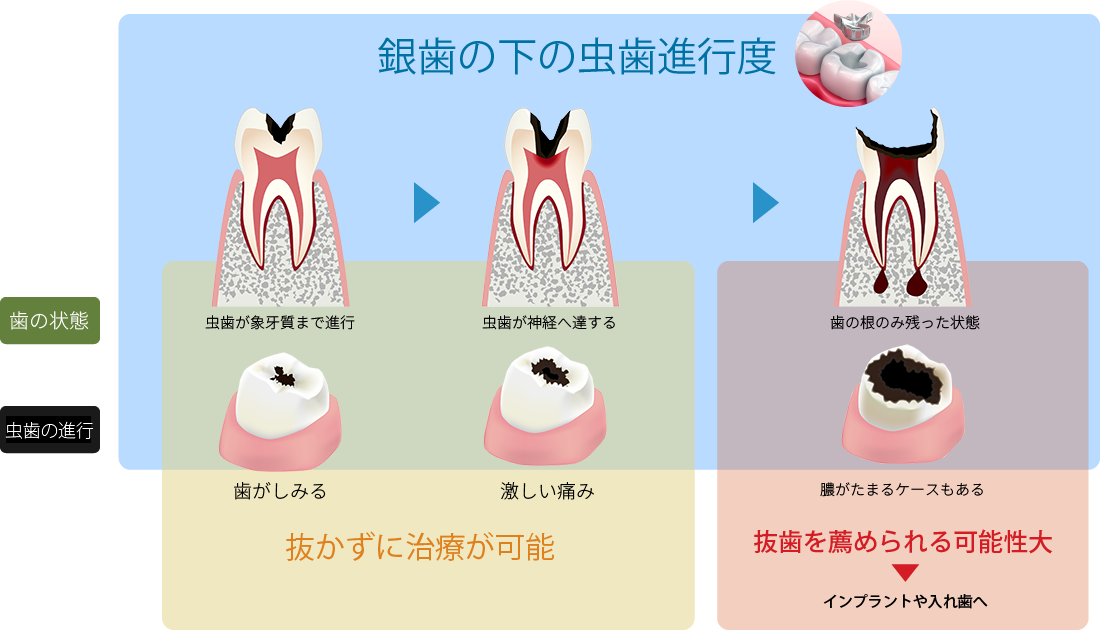 銀歯の下の虫歯進行度