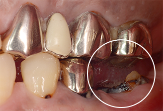 歯肉弁根尖側移動術（APF）治療前