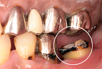 歯肉弁根尖側移動術（APF）治療後